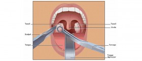 Tonsillitis, Tonsillectomy, Adenoidectomy and possible side effects