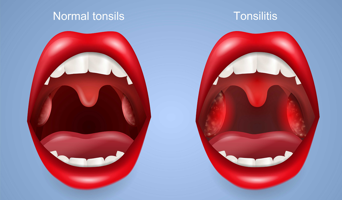 New Guidelines for Children's Tonsillectomies | Children's & Teens ...