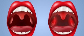 New Guidelines for Children's Tonsillectomies