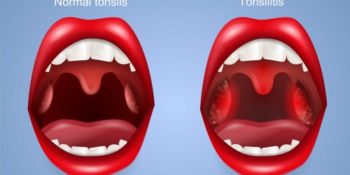 New Guidelines for Children's Tonsillectomies