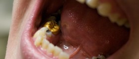 What Kind Of Crown Is Best For The Teeth?