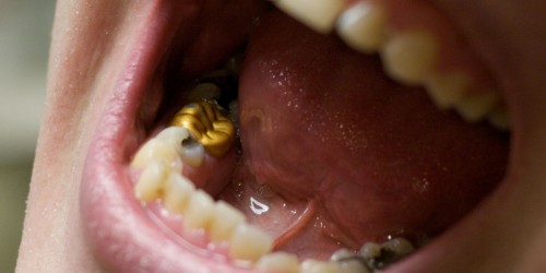 What Kind Of Crown Is Best For The Teeth?
