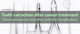 Tooth extraction after cancer treatment: Osteoradionecrosis and other potential complications