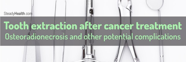 Tooth extraction after cancer treatment: Osteoradionecrosis and other potential complications