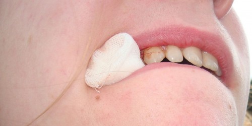 Tooth extraction: Would You Be Able To Recognize Infection And Other Complications?