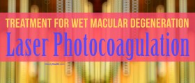 Treatment for Wet Macular Degeneration: Is Laser Photocoagulation The Treatment of Your Choice?