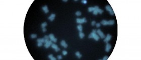 Trisomy 18