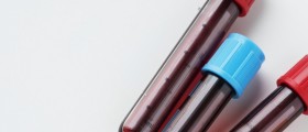 What's The Role Of Tryglicerides In LDL And VLDL Cholesterol Levels?
