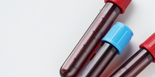 What's The Role Of Tryglicerides In LDL And VLDL Cholesterol Levels?