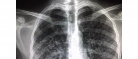 Extremely Drug-Resistant Tuberculosis Threatens Western Health Care System