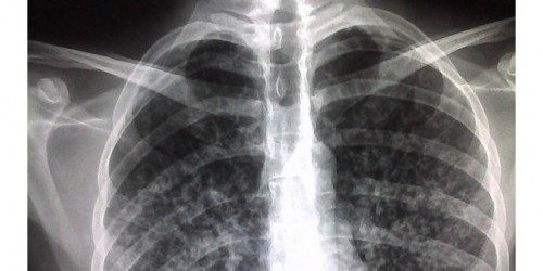 Extremely Drug-Resistant Tuberculosis Threatens Western Health Care System