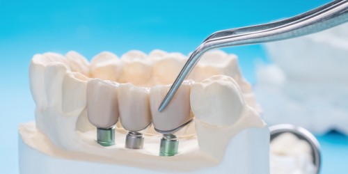 What Kinds of Crowns Can Be Placed On Dental Implants?