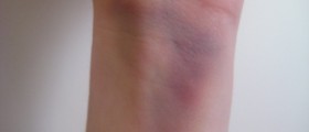 Living With Gaucher’s Disease