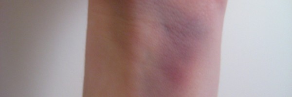 Living With Gaucher’s Disease