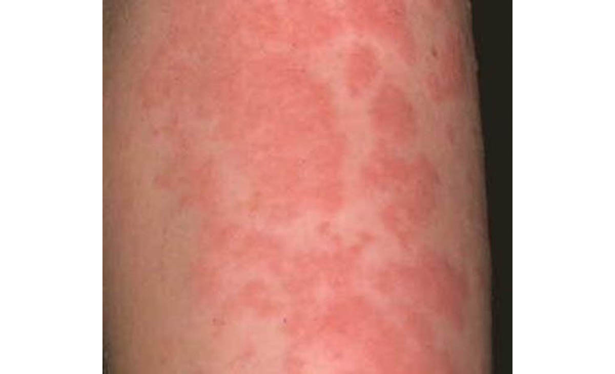 Urticaria Hives Or Angioedema Info Skin And Hair Problems Articles