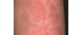 Urticaria (Hives or Angioedema) info