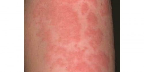 Urticaria (Hives or Angioedema) info