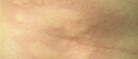 Urticaria Treatment: Medical And Natural Solutions That Help Treat Hives