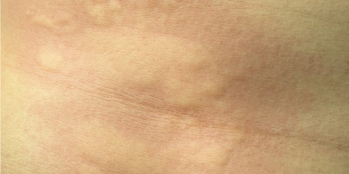Urticaria Treatment: Medical And Natural Solutions That Help Treat Hives