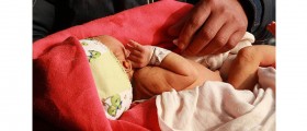 Male Varicocele And Infertility: Myths And Reality