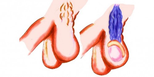 Varicocele embolization