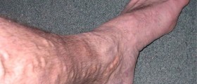 Varicose Veins: What, Why, And What To Do About Them