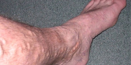 Varicose Veins: What, Why, And What To Do About Them