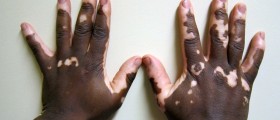 Living With Vitiligo - Causes And Treatments