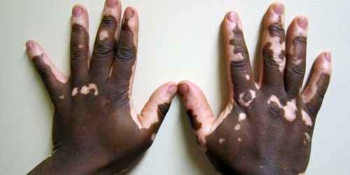 Living With Vitiligo - Causes And Treatments
