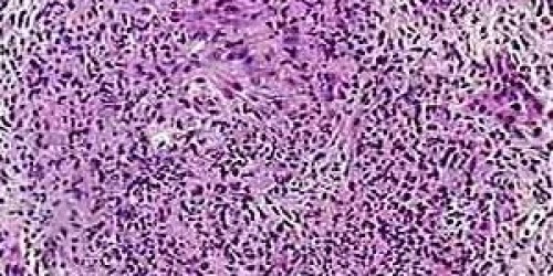 Granulomatosis with Polyangiitis (Formerly Wegener's Granulomatosis): Diagnosis & Treatment