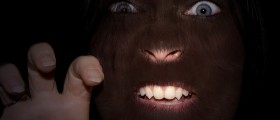 Hypertrichosis: The Hair You Wish You Never Had