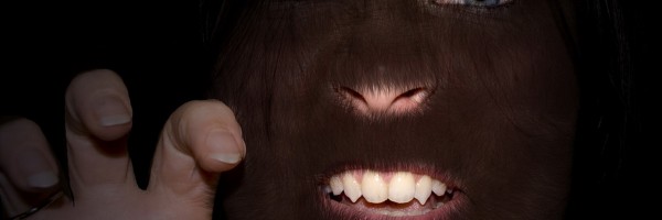 Hypertrichosis: The Hair You Wish You Never Had