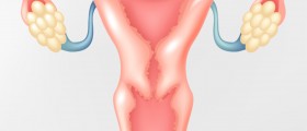 What Every Woman With Endometriosis Should Know About Ovarian Cancer