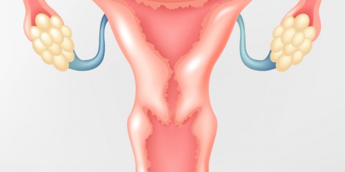 What Every Woman With Endometriosis Should Know About Ovarian Cancer