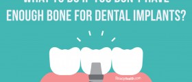What To Do If You Don't Have Enough Bone For Dental Implants?