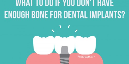 What To Do If You Don't Have Enough Bone For Dental Implants?