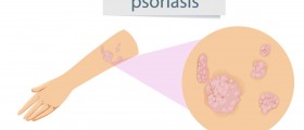 What You Should Know About Psoriatic Arthritis: Causes, Symptoms, Diagnosis, And Treatment