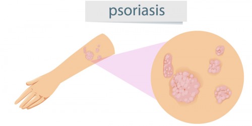 What You Should Know About Psoriatic Arthritis: Causes, Symptoms, Diagnosis, And Treatment