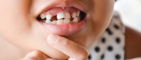 When Should Your Child's Milk Teeth Be Extracted? Will That Affect Your Child's Permanent Teeth?
