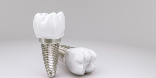 Which Kind Of A Dentist Can Perform Dental Implant Surgery?