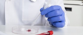 White Blood Cell Count High: Scared? Here's What You Need To Know