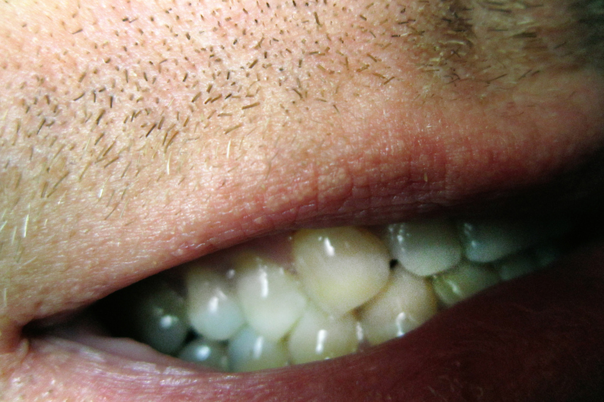 牙齿上长了一块一块的白斑？牙釉质脱矿、早期龋根本没听说过？让大白来告诉你，不是牙黑了才是“虫牙”～ - 知乎