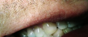 What Is That White Patch Inside Your Mouth?