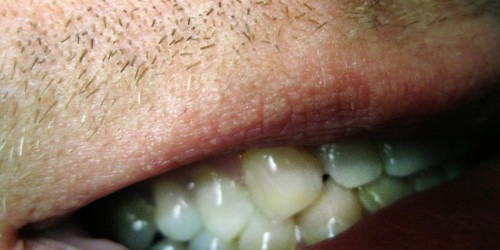 What Is That White Patch Inside Your Mouth?