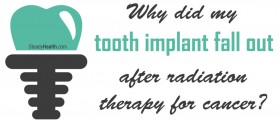 Why Did My Tooth Implant Fall Out After Radiation Therapy For Cancer?