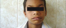 Children with Williams Syndrome, a Rare Genetic Disorder, Have No Racial Biases