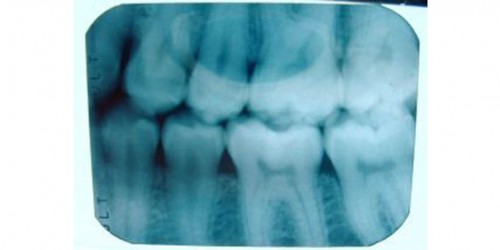 Pros and Cons of Wisdom Teeth Removal