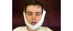 Should Wisdom Teeth Be Removed?