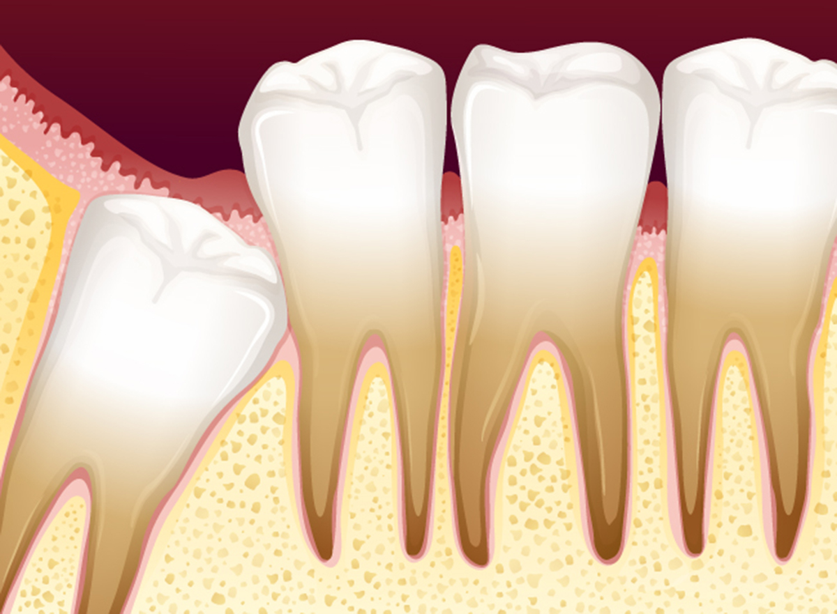 Wisdom Tooth Problems: Do You Need Your Impacted Wisdom Teeth Removed