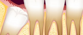 Wisdom Tooth Problems: Do You Need Your Impacted Wisdom Teeth Removed?